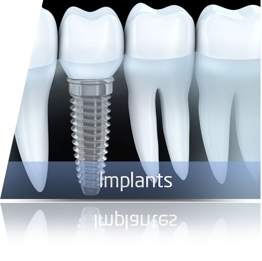 servicio implantes en