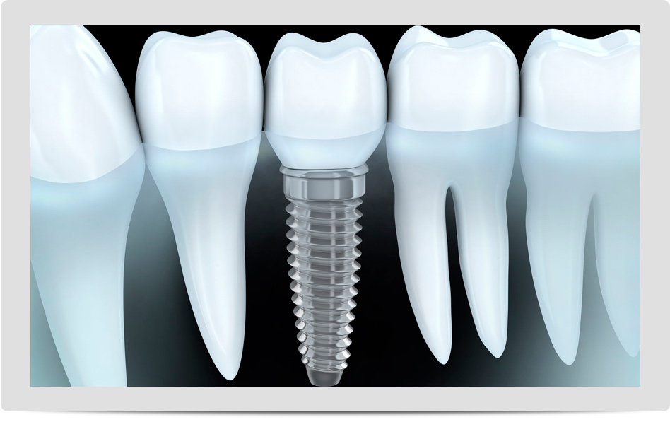 implantes